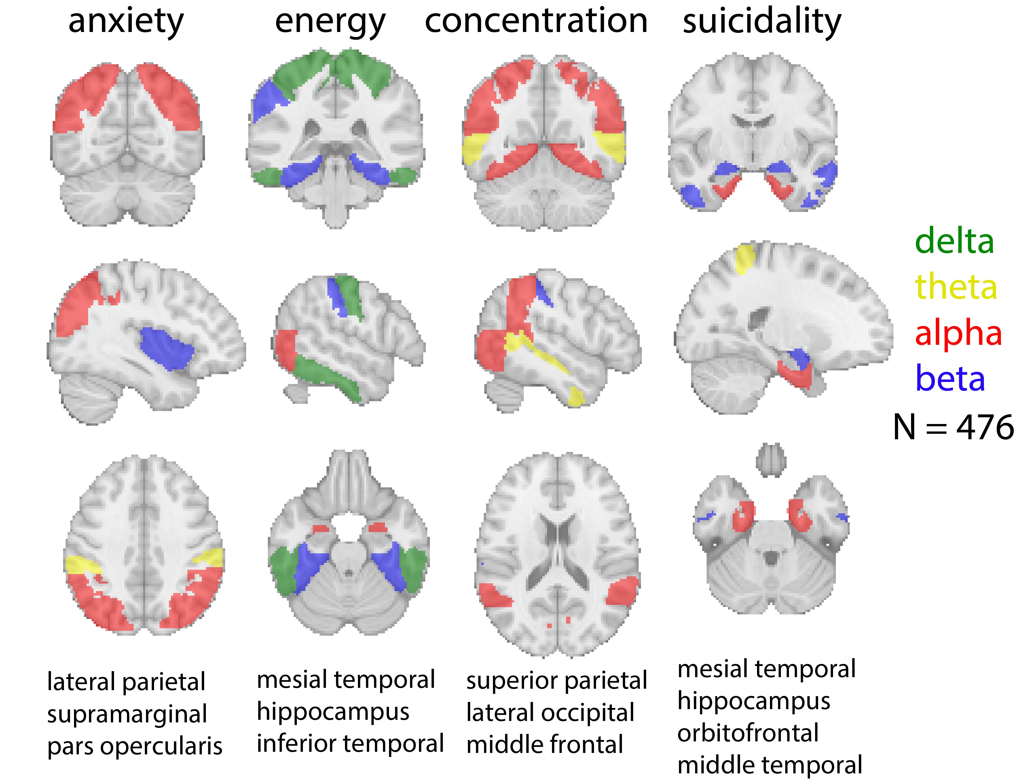 EEG-IntraMap predicted brain-clinical relationships. Brain regions and frequency bands in which EEG-IntraMap was predictive of anxiety, energy, concentration, and suicidality.