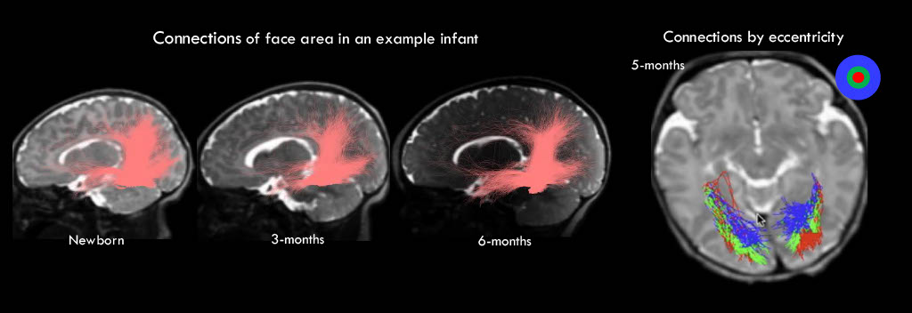 Scientific figure showing progression of white matter connections in the infant brain in the first months of life