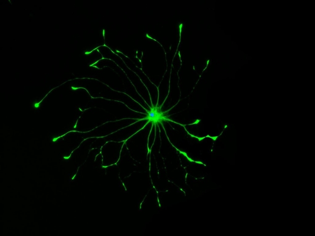 aberrant astrocytes