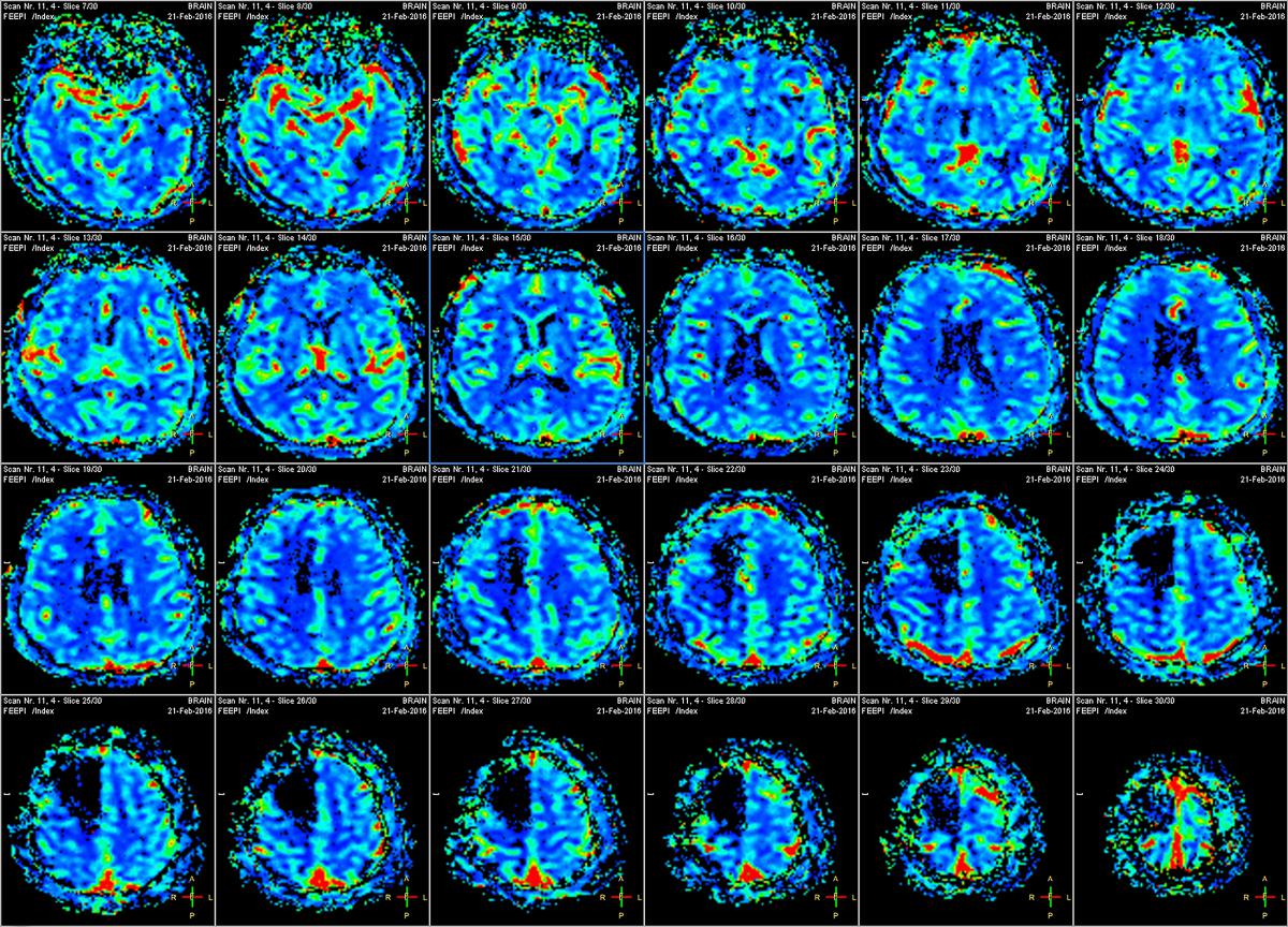 Geometric Analysis And Variability Mapping In Human White Matter Brain ...