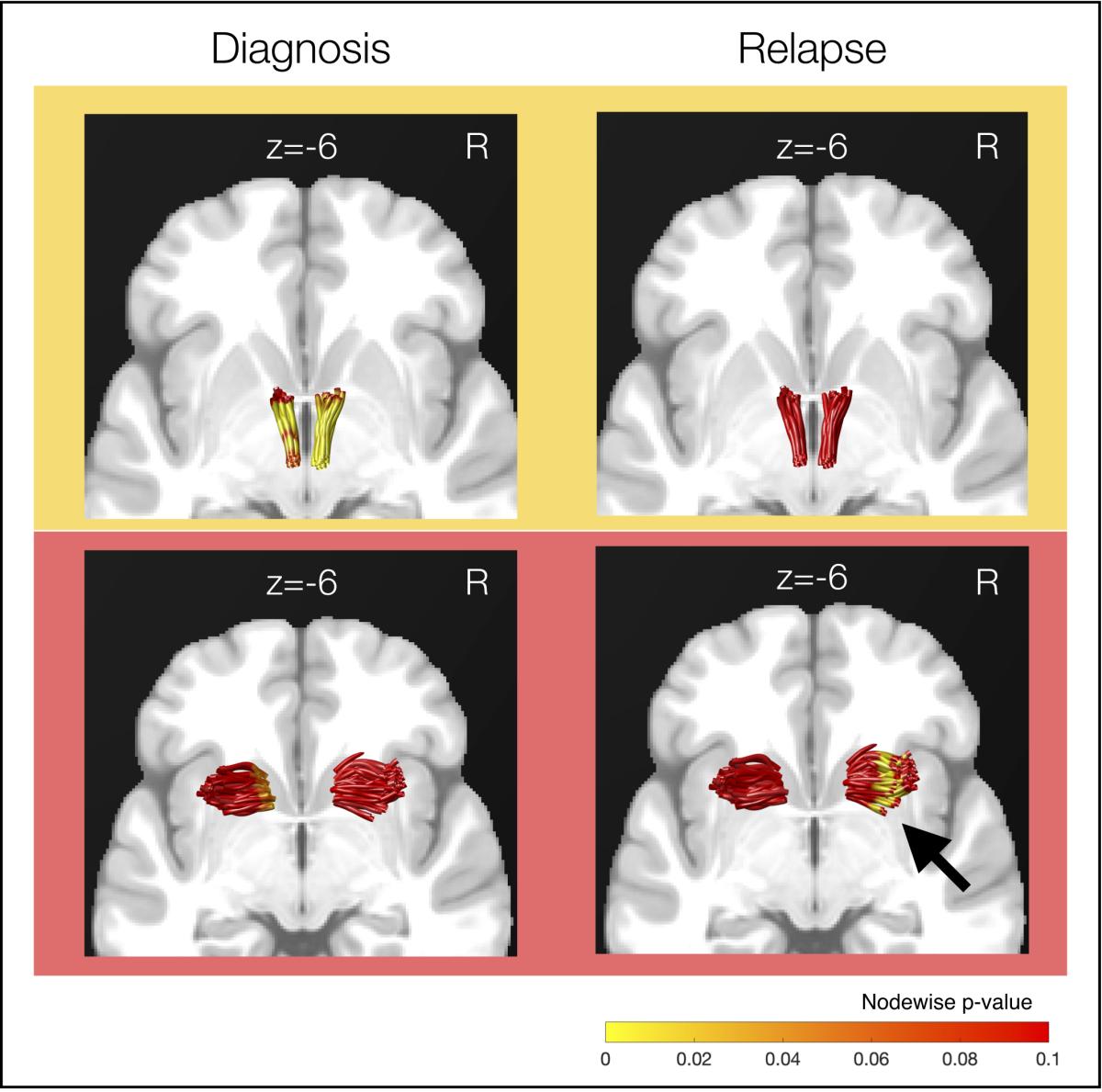 Figure showing distinct nerve fiber strength associated with stimulus use diagnosis and relapse