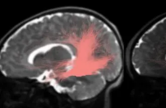 Three snapshots of white matter connections in the infant brain displayed in pink against grayscale brain images