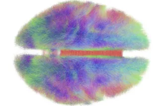 concussion damages corpus callosum