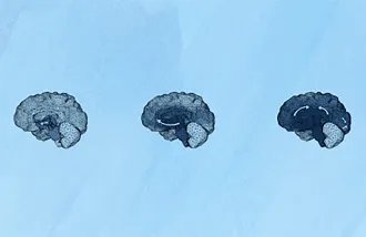 shows the progression of neurodegenerative diseases