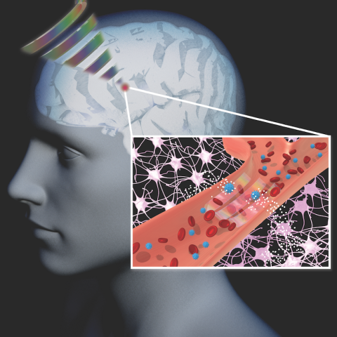 Schematic of a computer-rendered human head illustrating drug uncaging using focused ultrasound