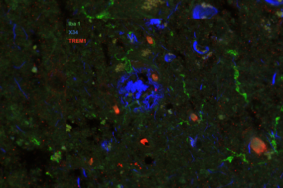 Image of post-mortem human frontal cortex showing TREM1 (red stain) in microglia and macrophages (Iba1; green stain) surrounding pathological amyloid buildup (X34; blue stain). The amount of TREM1 observed postmortem correlated with disease severity in Alzheimer’s patients.