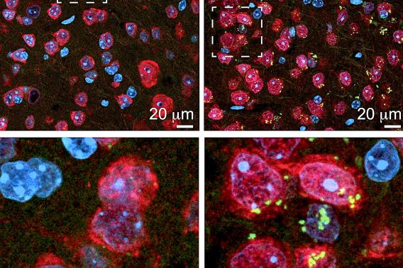 Four images with blobs of red, blue, and some green representing accumulating proteins in brain cells.