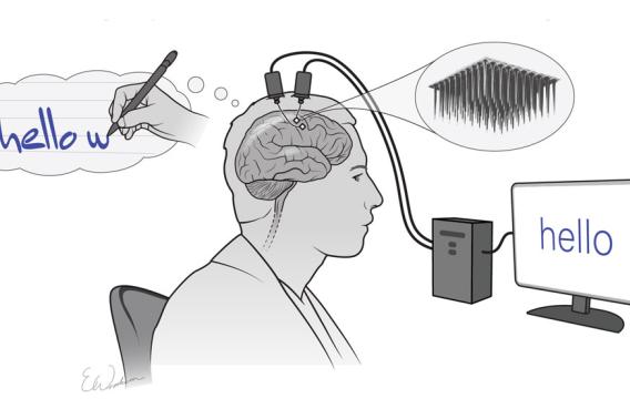 electrodes implanted in his brain imagined writing 